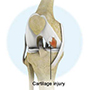 Knee Cartilage Injury