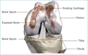 knee with advanced osteoarthritis