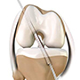 ACL Reconstruction