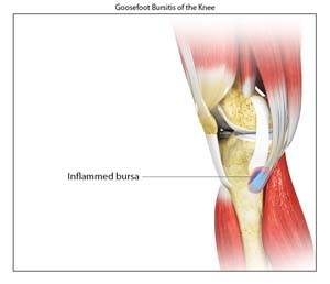 Goosefoot Bursitis of the Knee