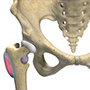 Hip Bursitis