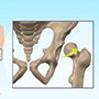 Hip Dysplasia