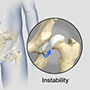 Hip Instability