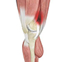 Iliotibial Band Syndrome