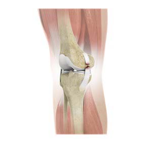 Meniscal Injuries