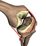 Meniscus Tear Surgery