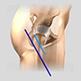 Minimally Hip Replacement