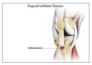 Osgood Schlatter Disease