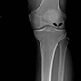 Osteonecrosis of the Knee