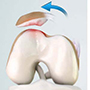 Patellar Dislocation