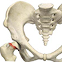 Slipped Capital Femoral Epiphysis