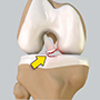 Tibial Eminence Spine Avulsions