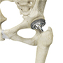 Total Hip Replacement