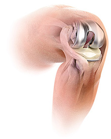 ATTUNE® Knee