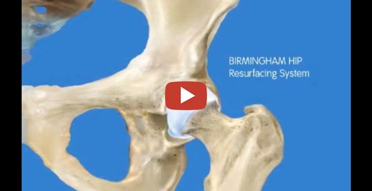 BHR Hip Animation