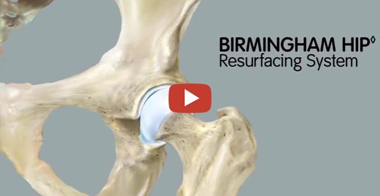 BIRMINGHAM HIP - (BHR) Resurfacing System
