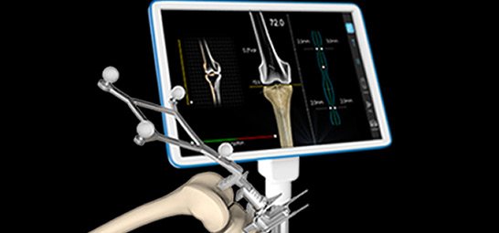 Computer Assisted Surgery