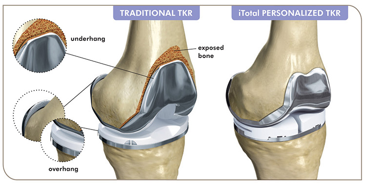 Traditional TKR iTotal Personilized TKR