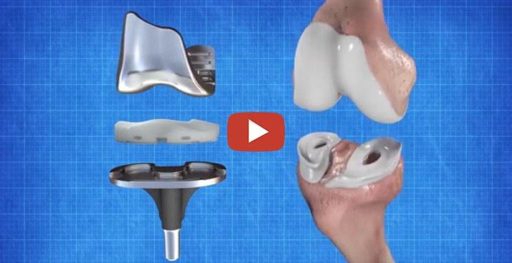 JOURNEY II - Total Knee Replacement