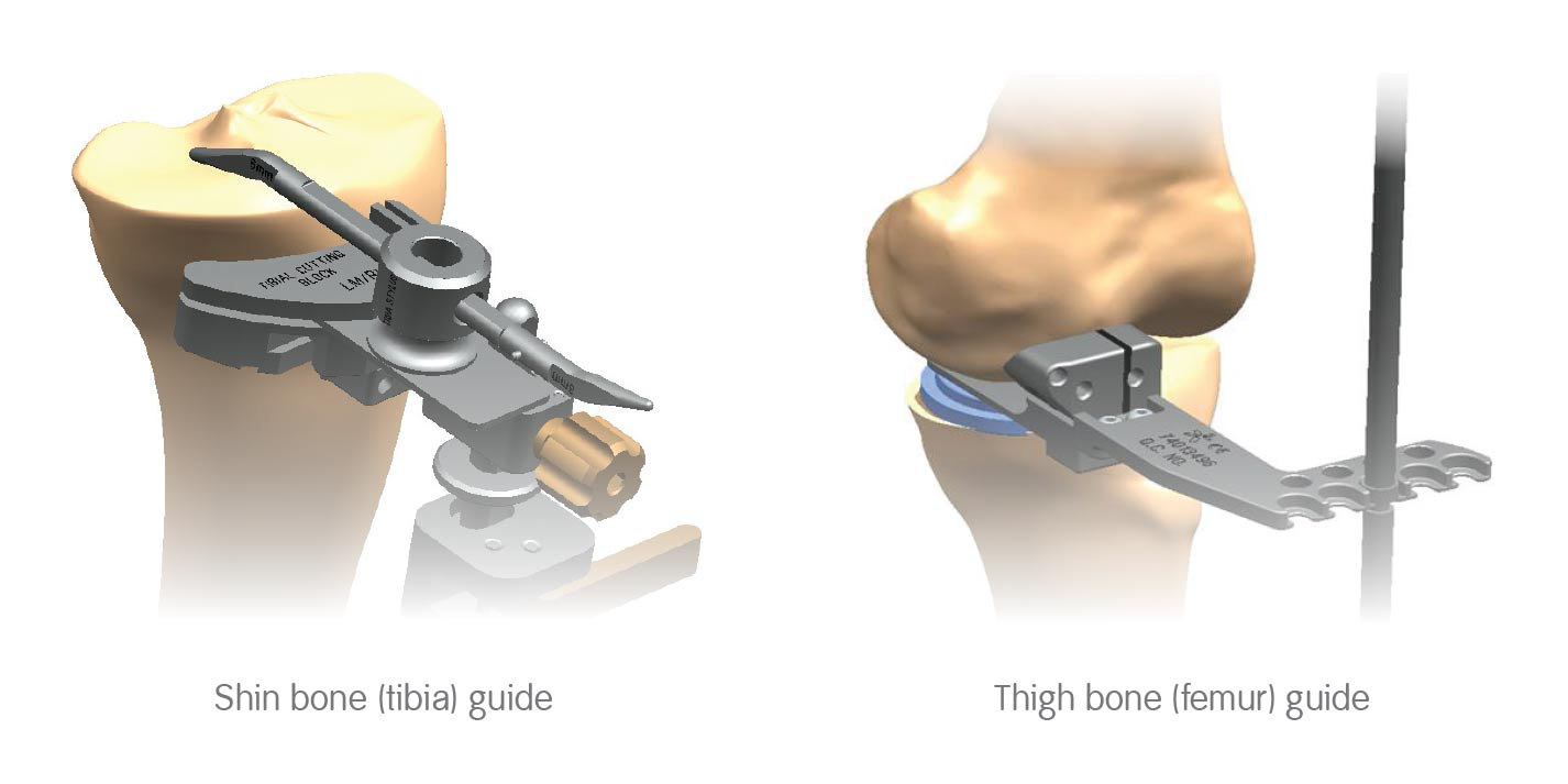 Navio Surgical System