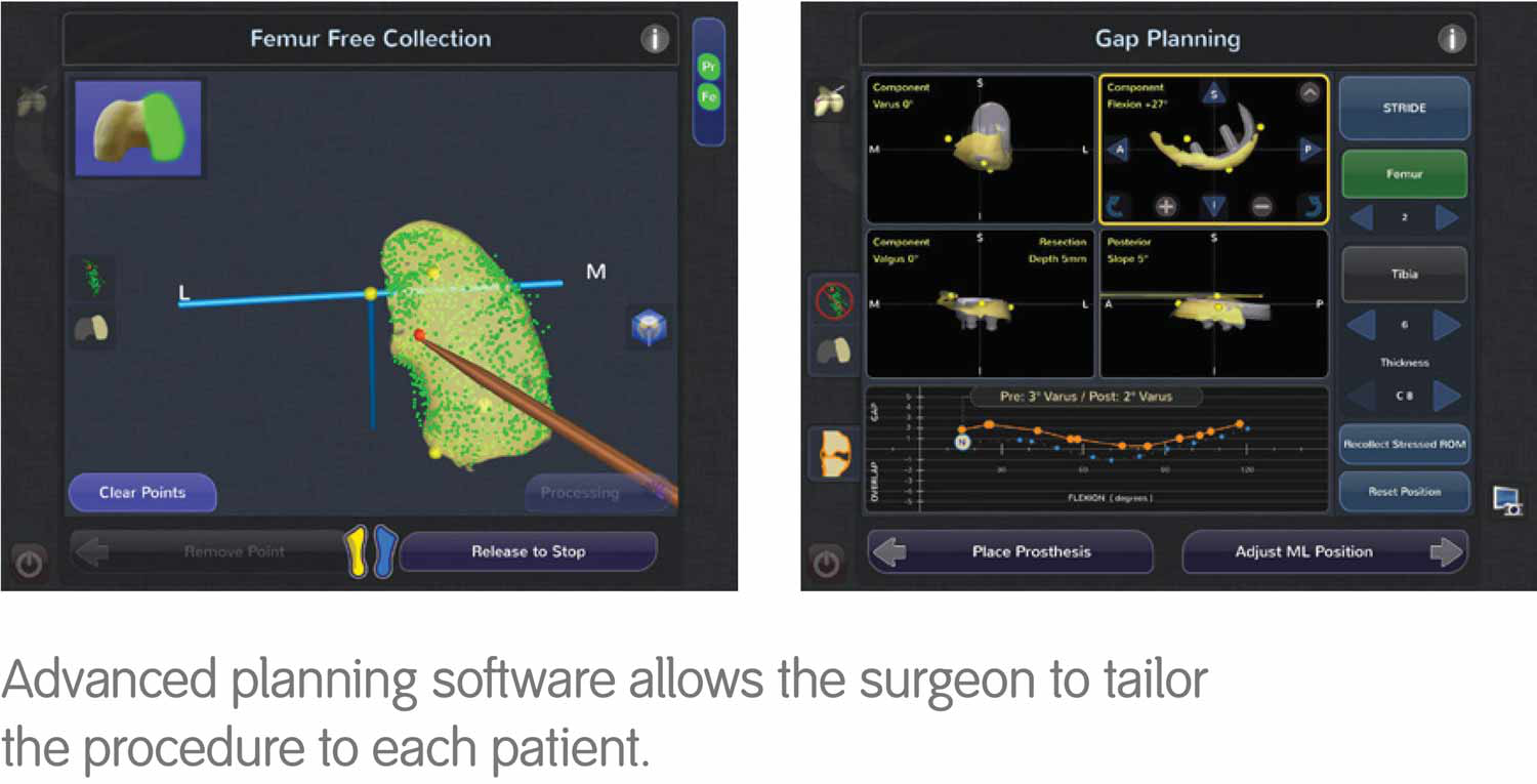 Navio Surgical System